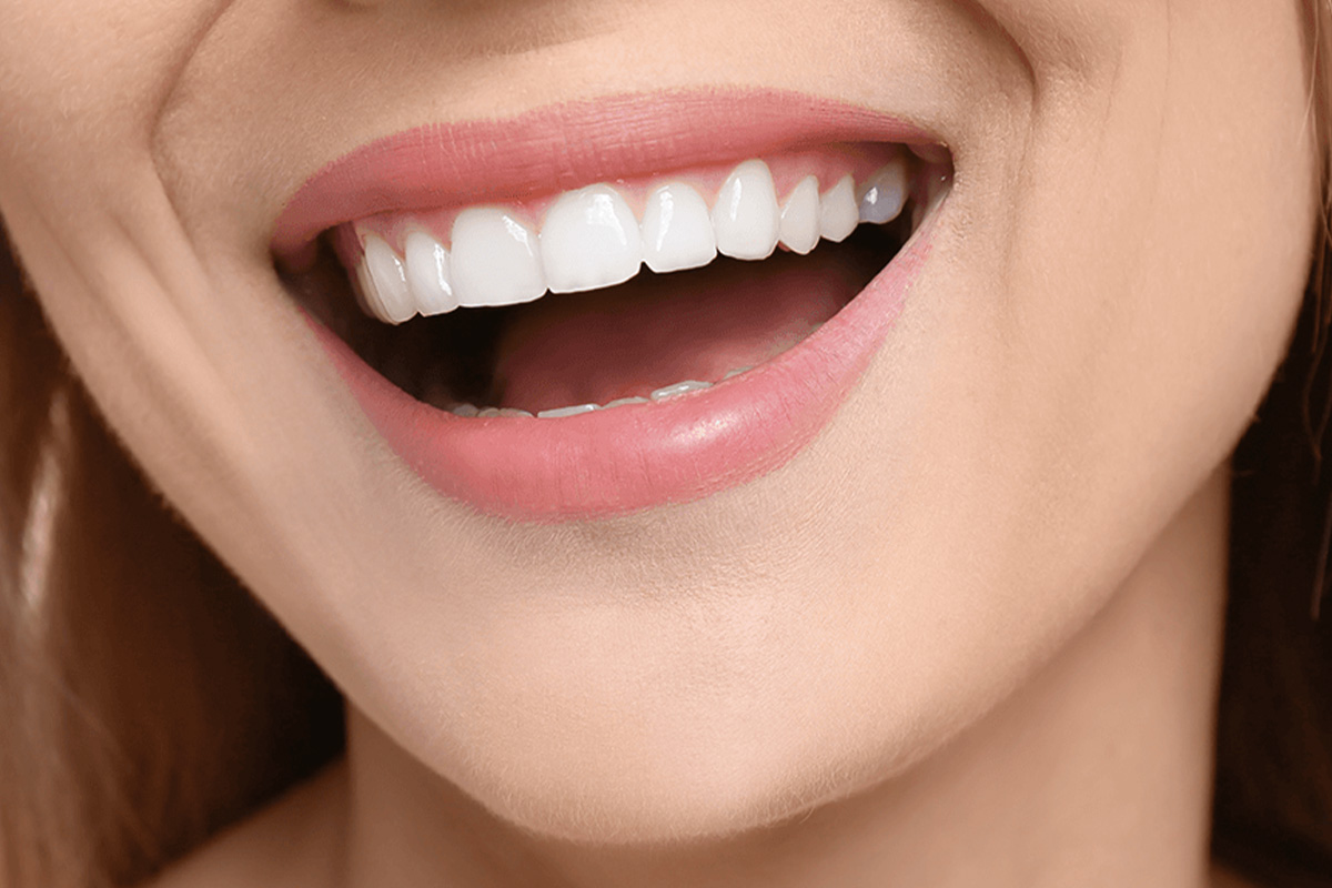 Hollywood Smile in der Türkei